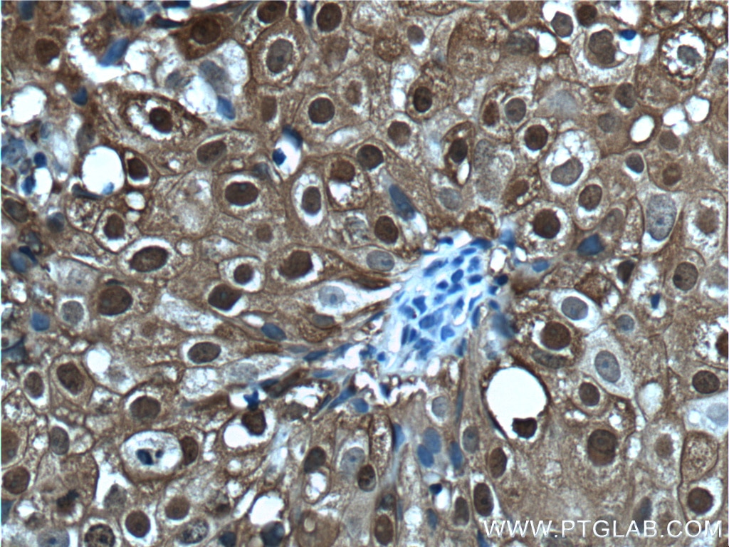 Immunohistochemistry (IHC) staining of human breast cancer tissue using S100A9 Polyclonal antibody (26992-1-AP)