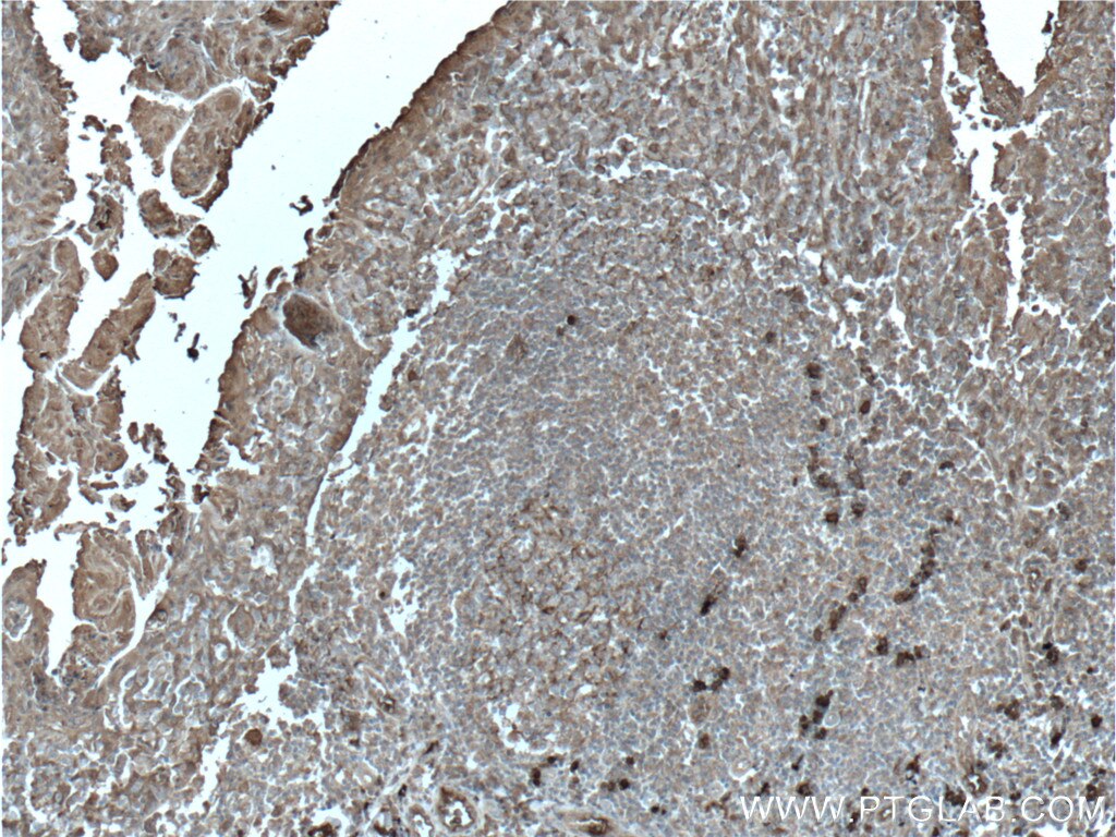 IHC staining of human tonsillitis using 26992-1-AP