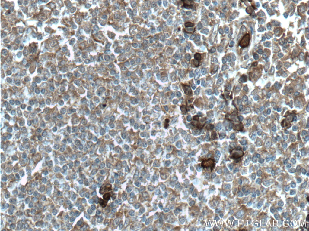 Immunohistochemistry (IHC) staining of human tonsillitis tissue using S100A9 Polyclonal antibody (26992-1-AP)