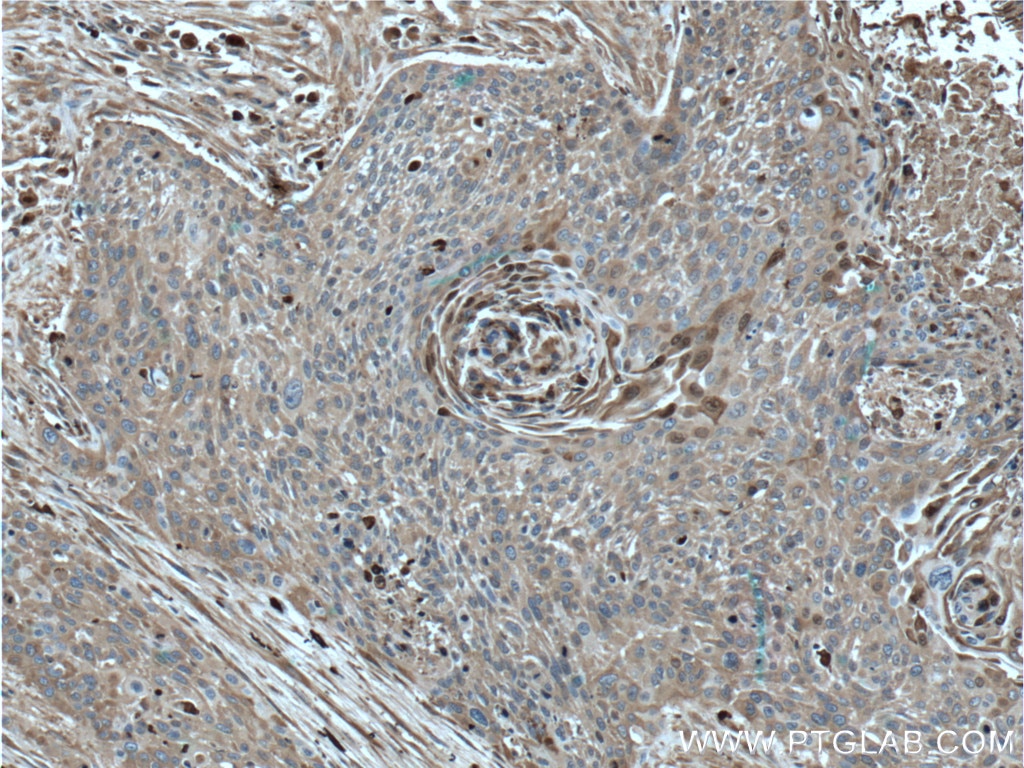 Immunohistochemistry (IHC) staining of human oesophagus cancer tissue using S100A9 Polyclonal antibody (26992-1-AP)