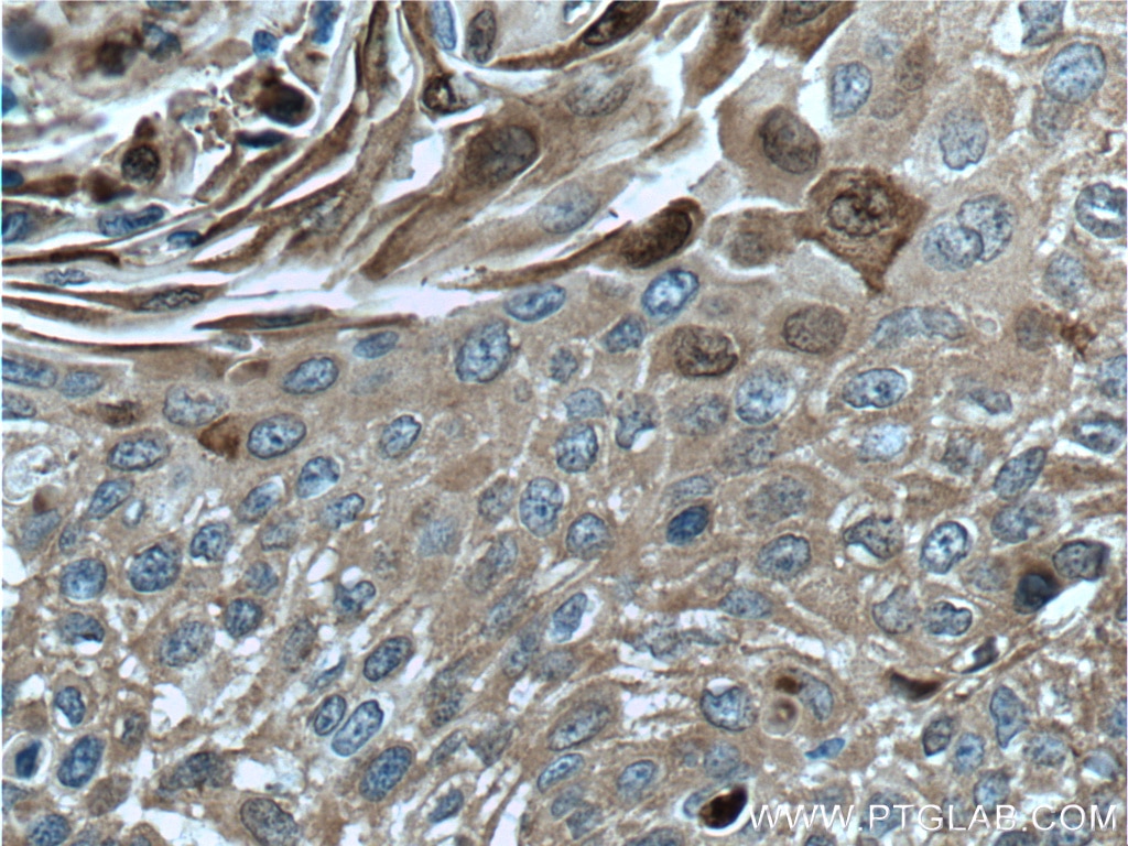 Immunohistochemistry (IHC) staining of human oesophagus cancer tissue using S100A9 Polyclonal antibody (26992-1-AP)