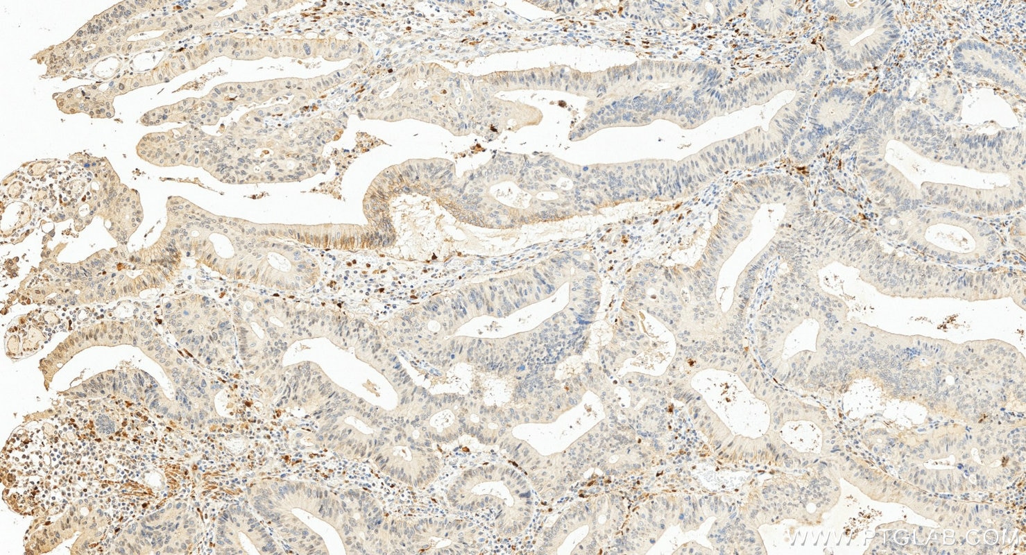Immunohistochemistry (IHC) staining of human colon cancer tissue using S100B Polyclonal antibody (15146-1-AP)