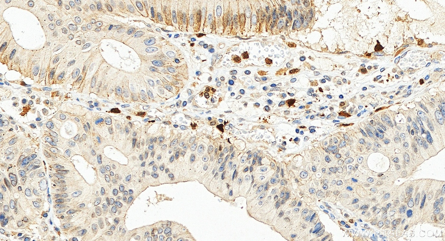 Immunohistochemistry (IHC) staining of human colon cancer tissue using S100B Polyclonal antibody (15146-1-AP)