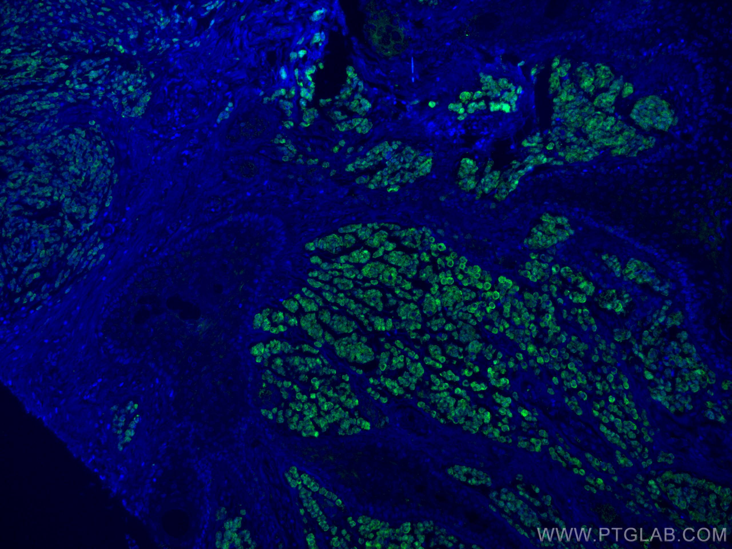 Immunofluorescence (IF) / fluorescent staining of human malignant melanoma tissue using S100 Beta Polyclonal antibody (15146-1-AP)