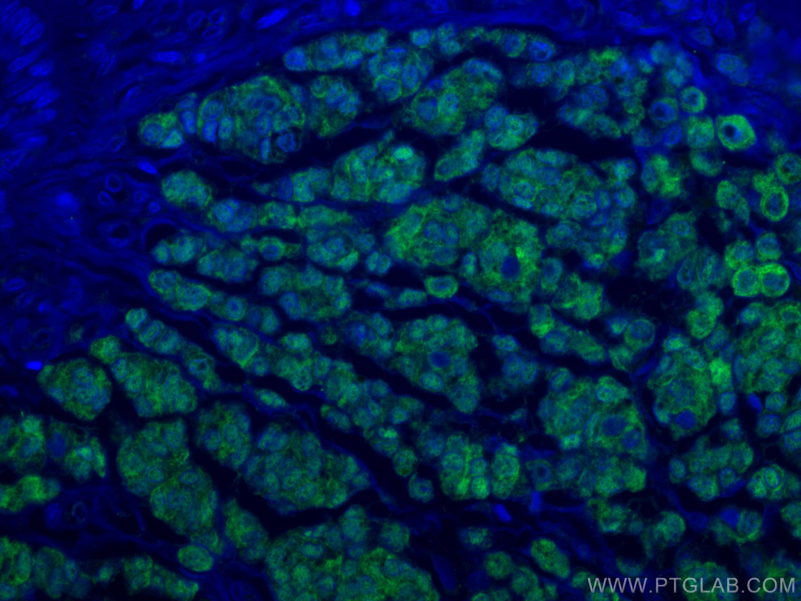 Immunofluorescence (IF) / fluorescent staining of human malignant melanoma tissue using S100 Beta Polyclonal antibody (15146-1-AP)