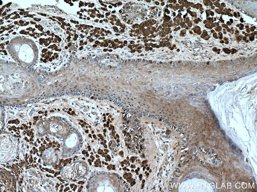 Immunohistochemistry (IHC) staining of human malignant melanoma tissue using S100 Beta Polyclonal antibody (15146-1-AP)