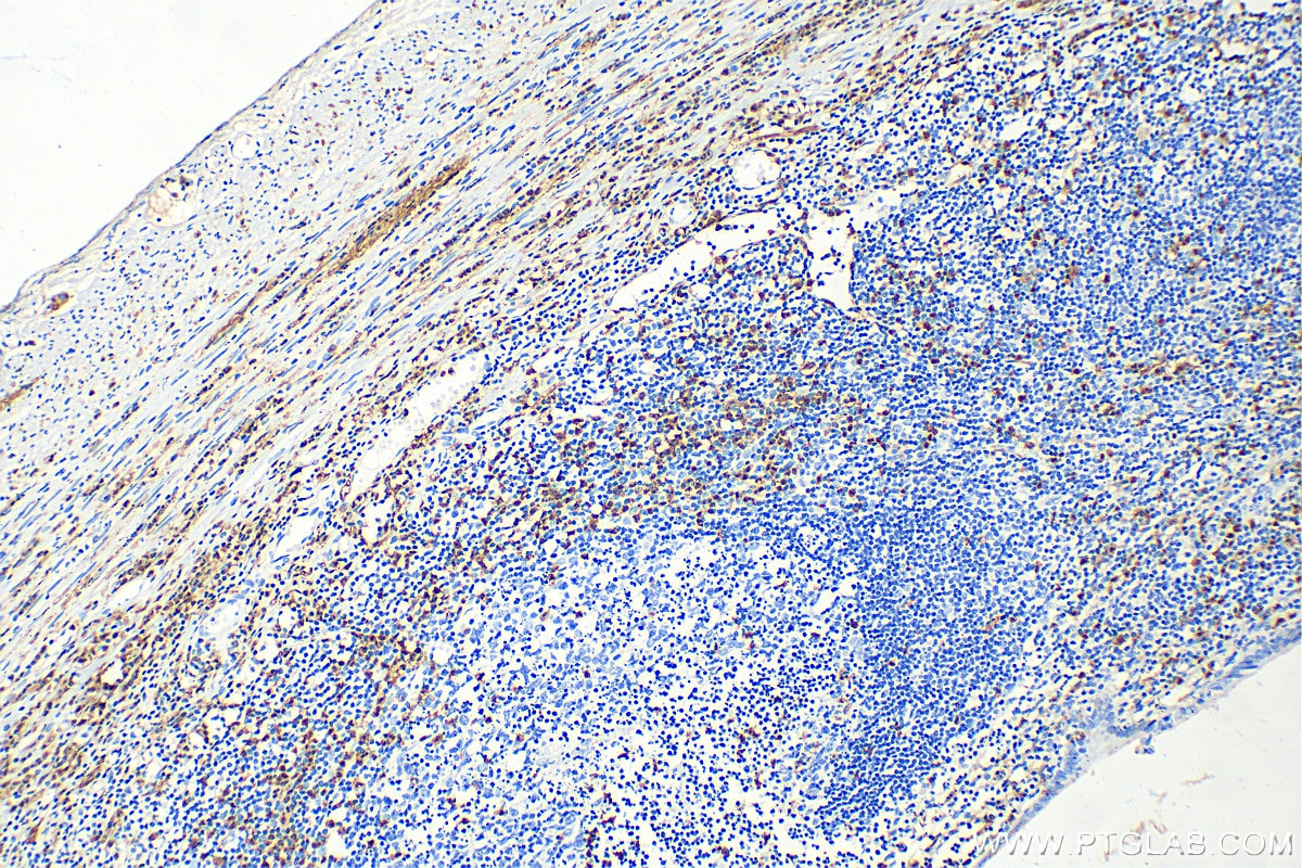 Immunohistochemistry (IHC) staining of human appendicitis tissue using S100 Beta Polyclonal antibody (15146-1-AP)