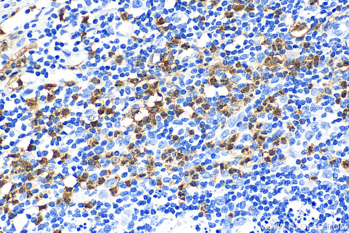 Immunohistochemistry (IHC) staining of human appendicitis tissue using S100 Beta Polyclonal antibody (15146-1-AP)