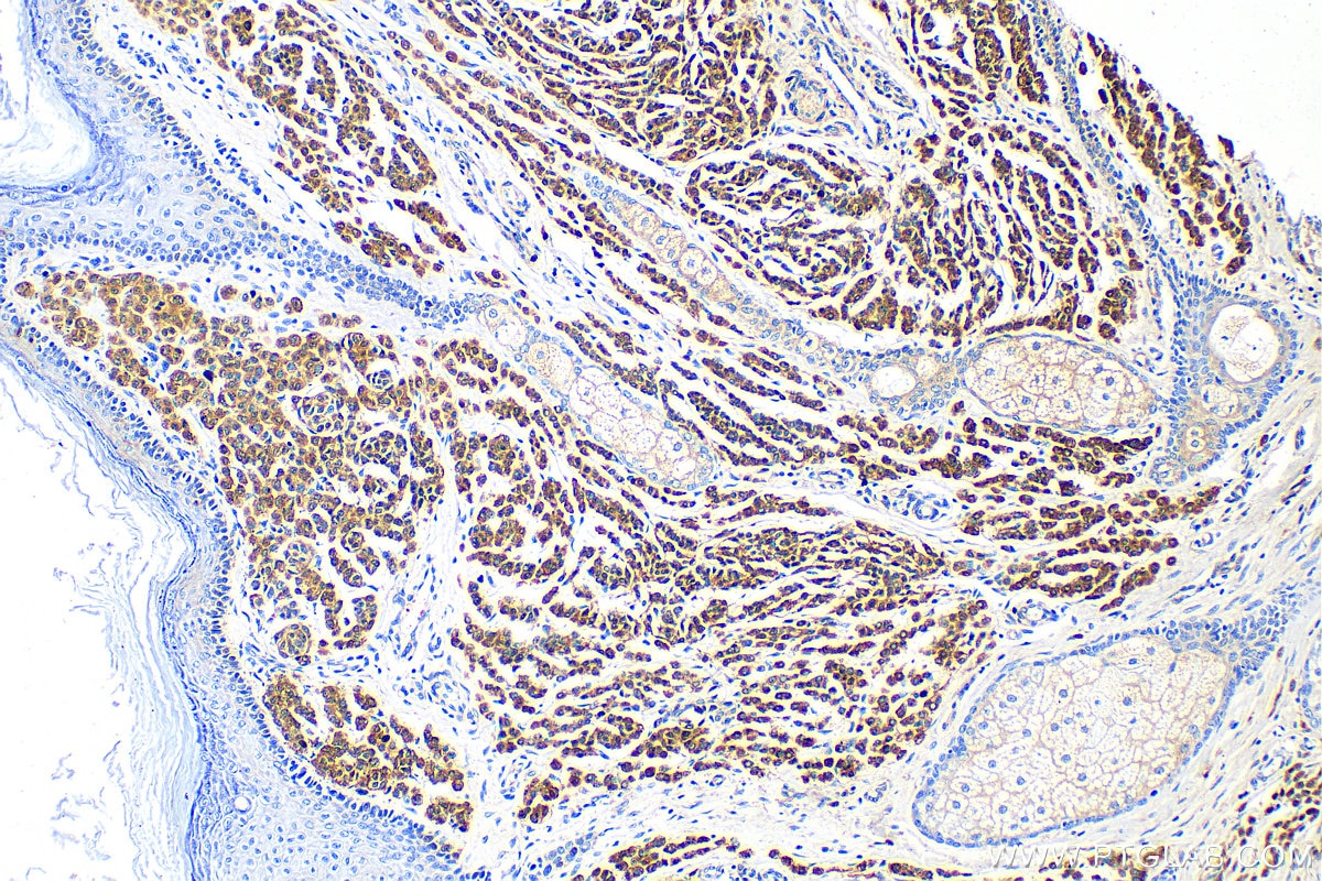 Immunohistochemistry (IHC) staining of human malignant melanoma tissue using S100 Beta Polyclonal antibody (15146-1-AP)