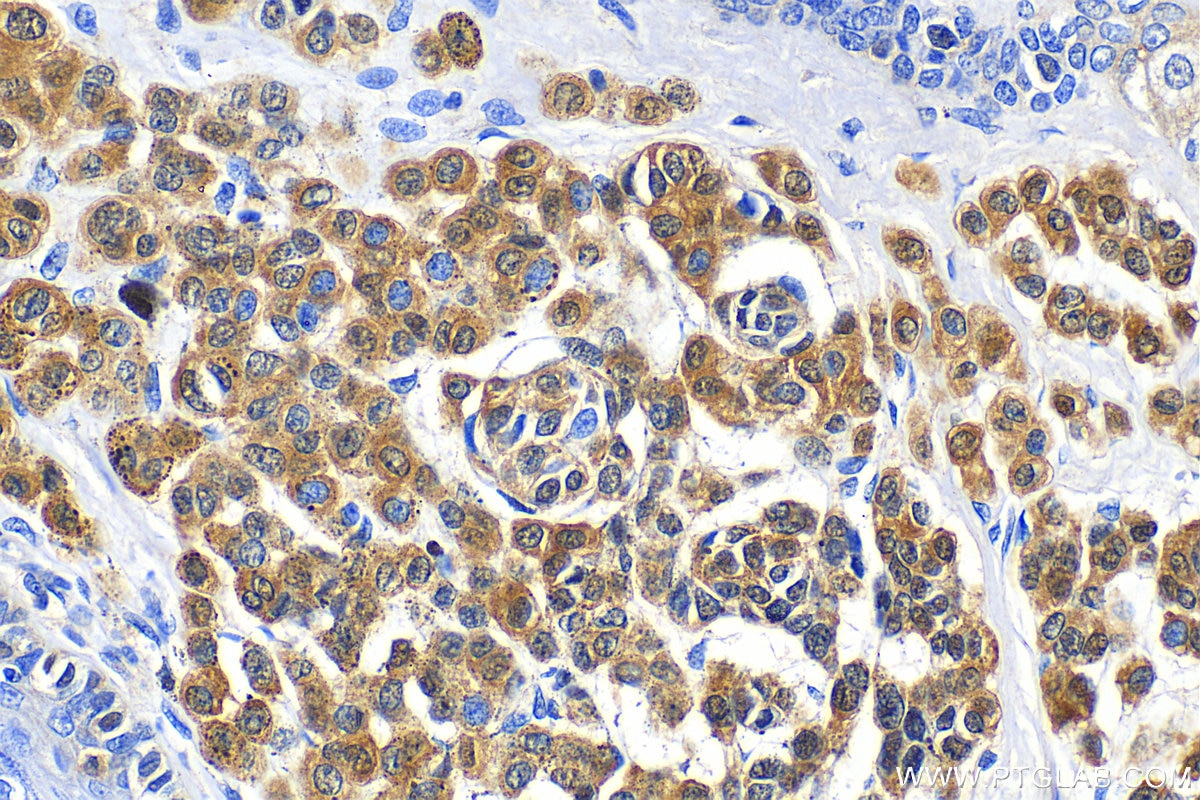 Immunohistochemistry (IHC) staining of human malignant melanoma tissue using S100 Beta Polyclonal antibody (15146-1-AP)