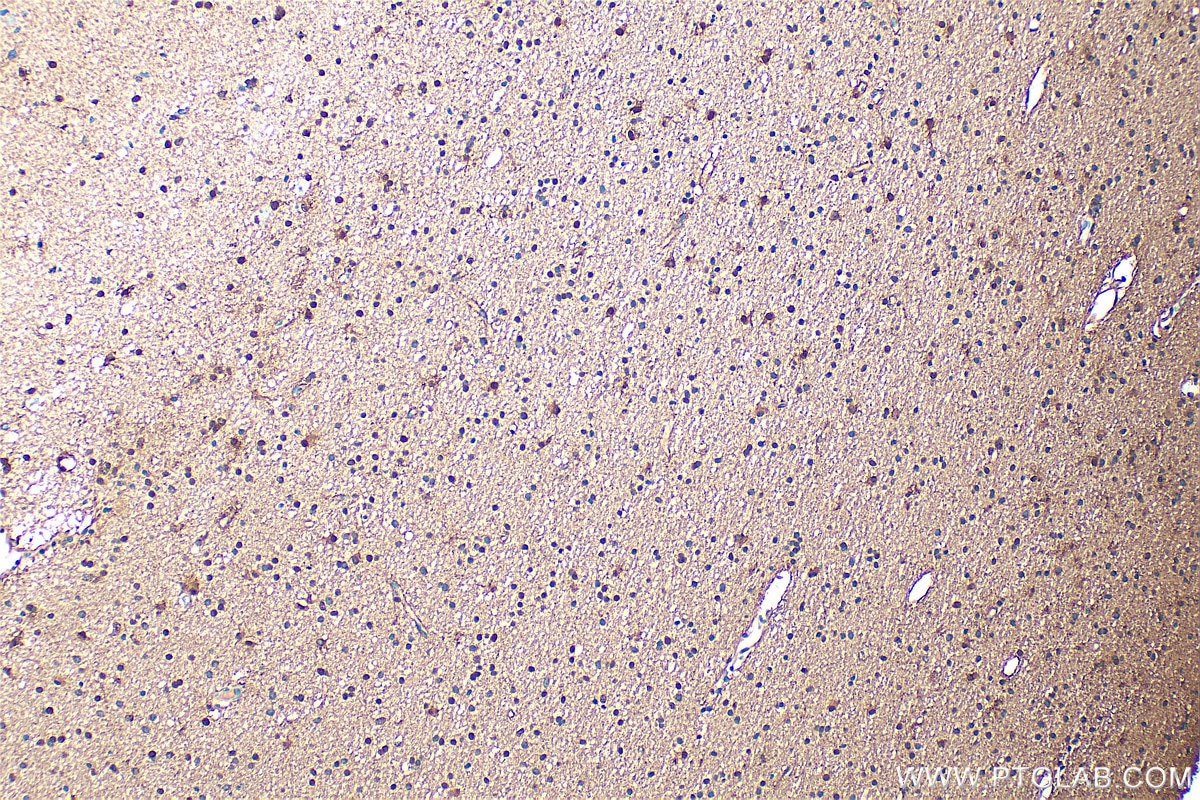 Immunohistochemistry (IHC) staining of human gliomas tissue using S100B Polyclonal antibody (15146-1-AP)