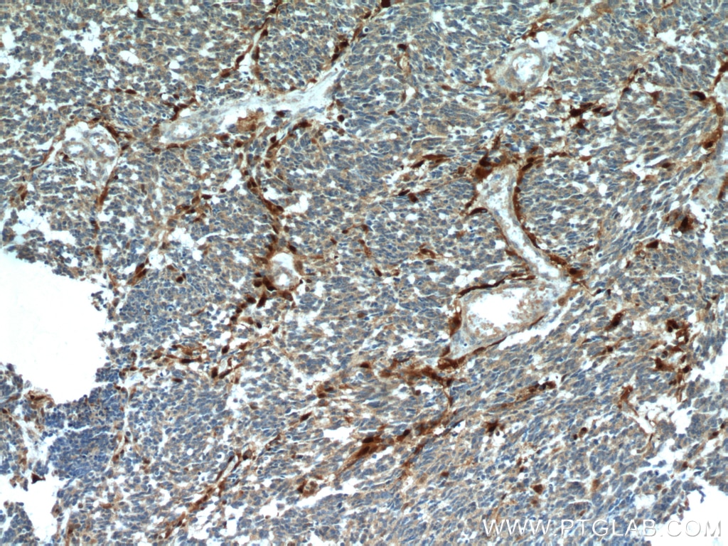 Immunohistochemistry (IHC) staining of human gliomas tissue using S100 Beta Polyclonal antibody (15146-1-AP)