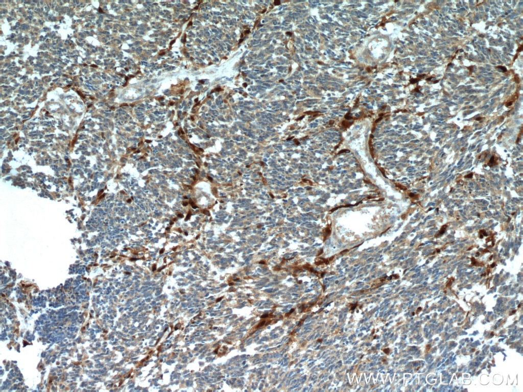 IHC staining of human gliomas using 15146-1-AP