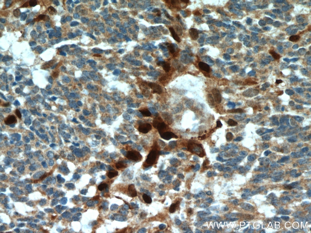 Immunohistochemistry (IHC) staining of human gliomas tissue using S100 Beta Polyclonal antibody (15146-1-AP)