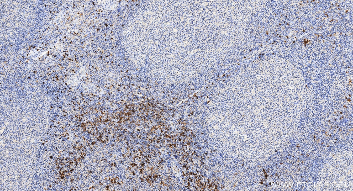 Immunohistochemistry (IHC) staining of human tonsillitis tissue using S100B Polyclonal antibody (15146-1-AP)