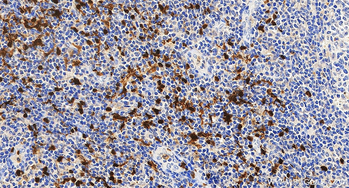 Immunohistochemistry (IHC) staining of human tonsillitis tissue using S100B Polyclonal antibody (15146-1-AP)