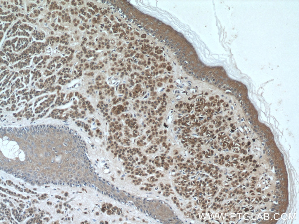 Immunohistochemistry (IHC) staining of human malignant melanoma tissue using S100 Beta Monoclonal antibody (66616-1-Ig)