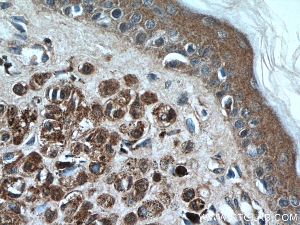 Immunohistochemistry (IHC) staining of human malignant melanoma tissue using S100 Beta Monoclonal antibody (66616-1-Ig)