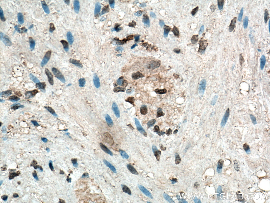 Immunohistochemistry (IHC) staining of human appendicitis tissue using S100 Beta Monoclonal antibody (66616-1-Ig)