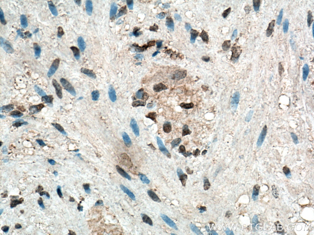 IHC staining of human appendicitis using 66616-1-Ig