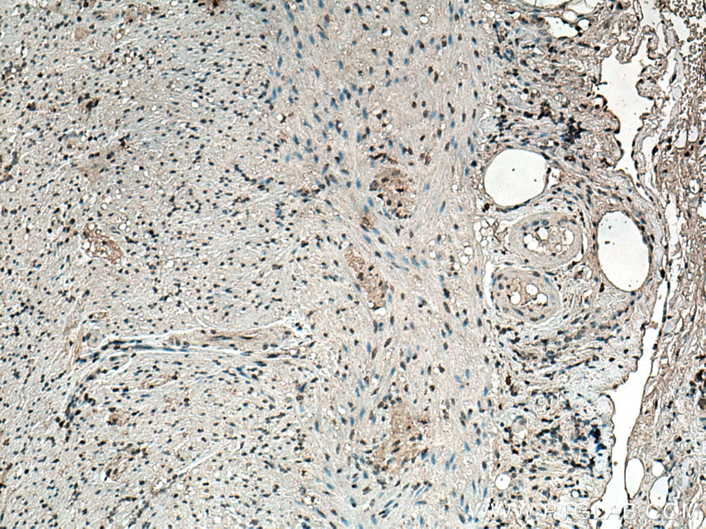 IHC staining of human appendicitis using 66616-1-Ig