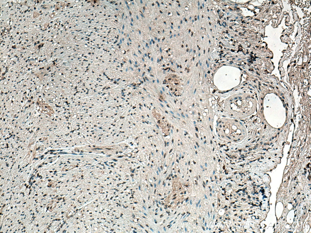 Immunohistochemistry (IHC) staining of human appendicitis tissue using S100 Beta Monoclonal antibody (66616-1-Ig)