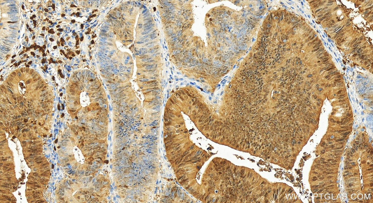 Immunohistochemical analysis of paraffin-embedded human colon cancer tissue slide using 11803-1-AP (S100P antibody) at dilution of 1:1200 (under 20x lens). Heat mediated antigen retrieval with Tris-EDTA buffer (pH 9.0). Immunohistochemistry (IHC) staining of human colon cancer tissue using S100P Polyclonal antibody (11803-1-AP)