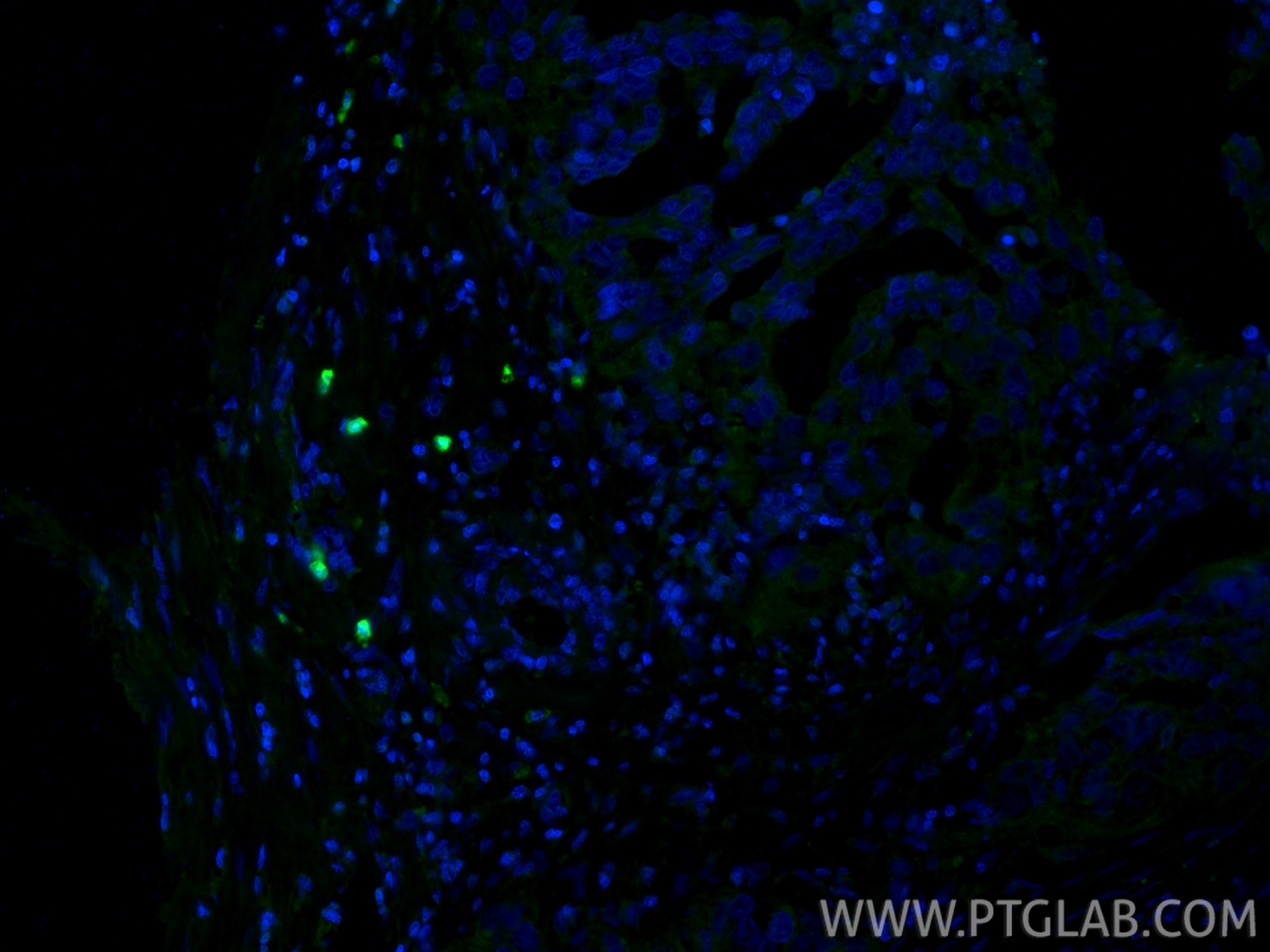 IF Staining of human colon cancer using 11803-1-AP Immunofluorescence (IF) / fluorescent staining of human colon cancer tissue using S100P Polyclonal antibody (11803-1-AP)
