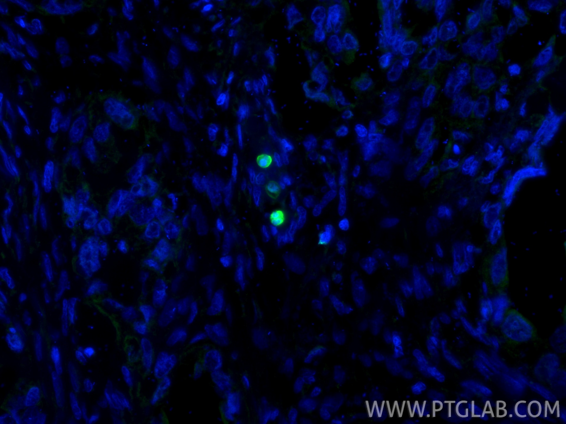 IF Staining of human colon cancer using 11803-1-AP Immunofluorescence (IF) / fluorescent staining of human colon cancer tissue using S100P Polyclonal antibody (11803-1-AP)