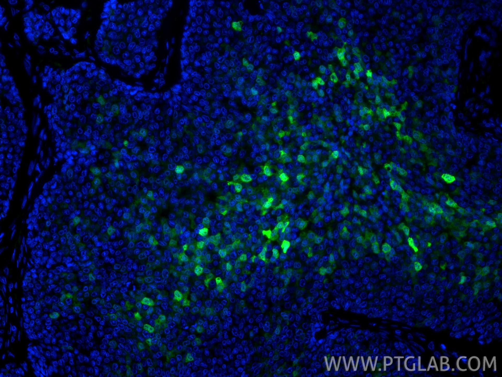 IF Staining of human breast cancer using 11803-1-AP Immunofluorescence (IF) / fluorescent staining of human breast cancer tissue using S100P Polyclonal antibody (11803-1-AP)