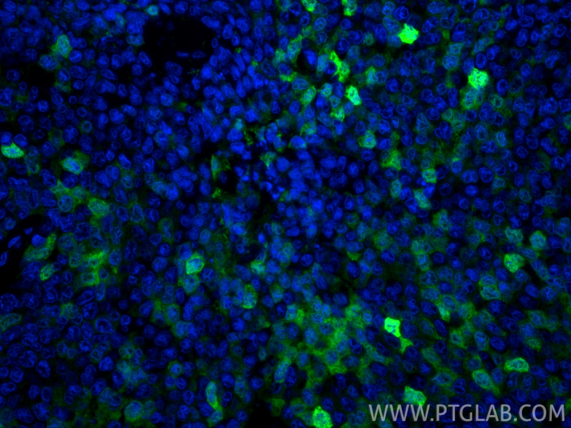 IF Staining of human breast cancer using 11803-1-AP Immunofluorescence (IF) / fluorescent staining of human breast cancer tissue using S100P Polyclonal antibody (11803-1-AP)