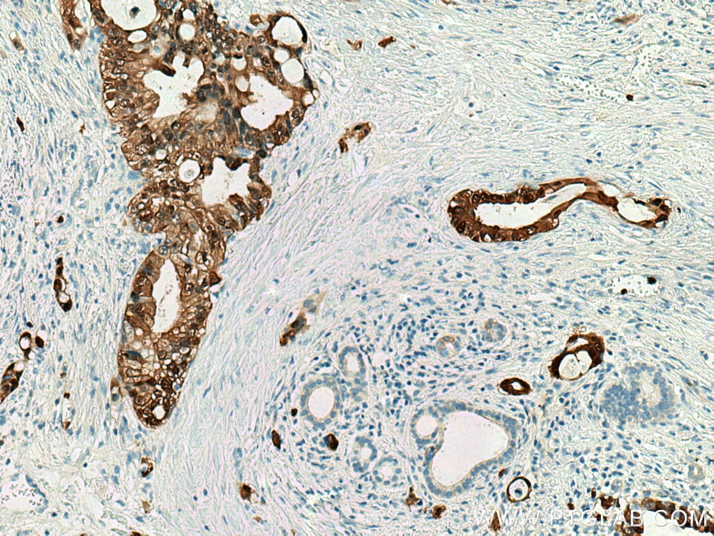 Immunohistochemistry (IHC) staining of human pancreas cancer tissue using S100P Polyclonal antibody (11803-1-AP)