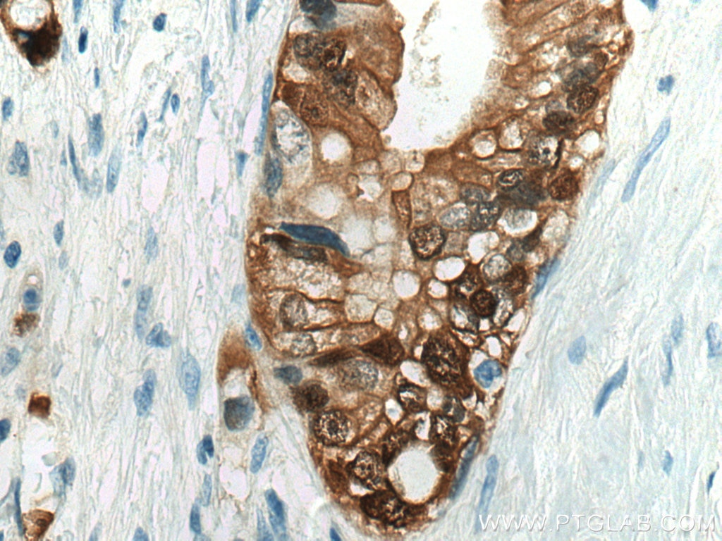Immunohistochemistry (IHC) staining of human pancreas cancer tissue using S100P Polyclonal antibody (11803-1-AP)