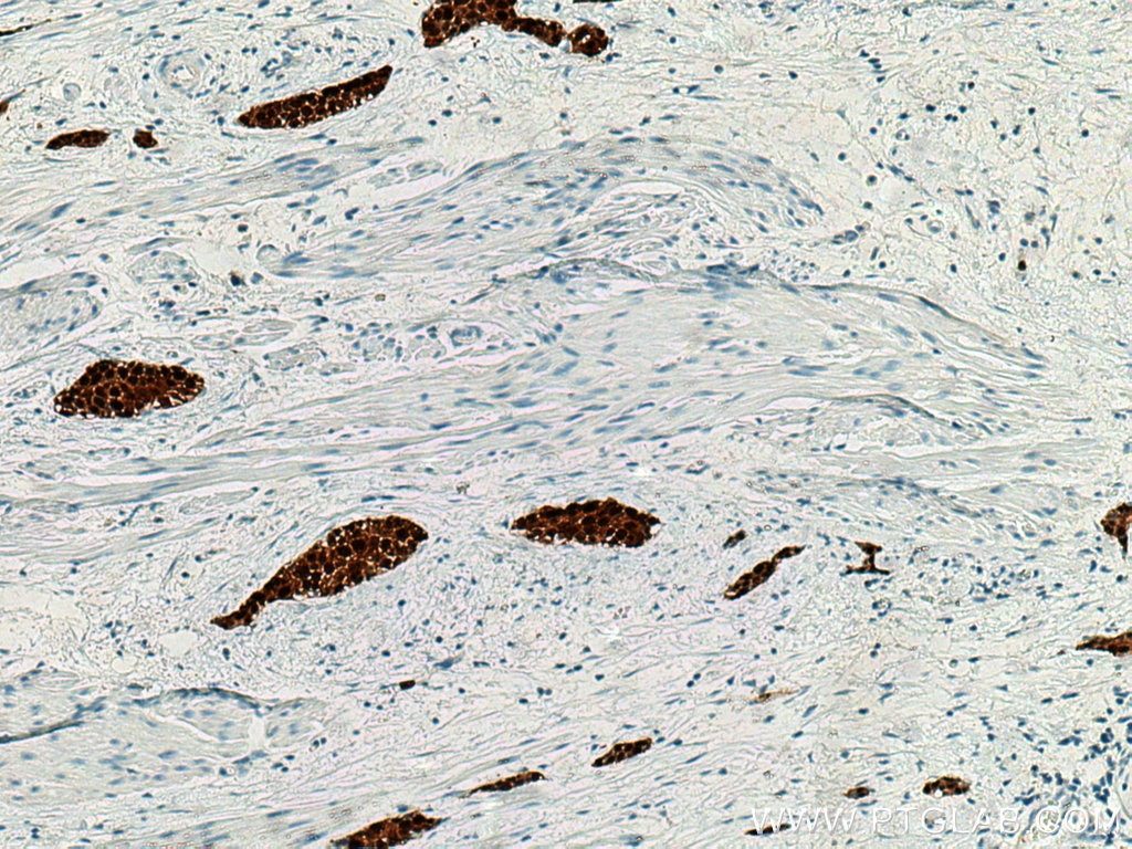 Immunohistochemistry (IHC) staining of human urothelial carcinoma tissue using S100P Polyclonal antibody (11803-1-AP)