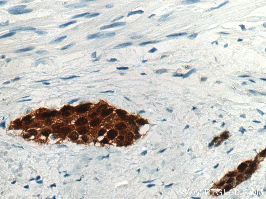 Immunohistochemistry (IHC) staining of human urothelial carcinoma tissue using S100P Polyclonal antibody (11803-1-AP)