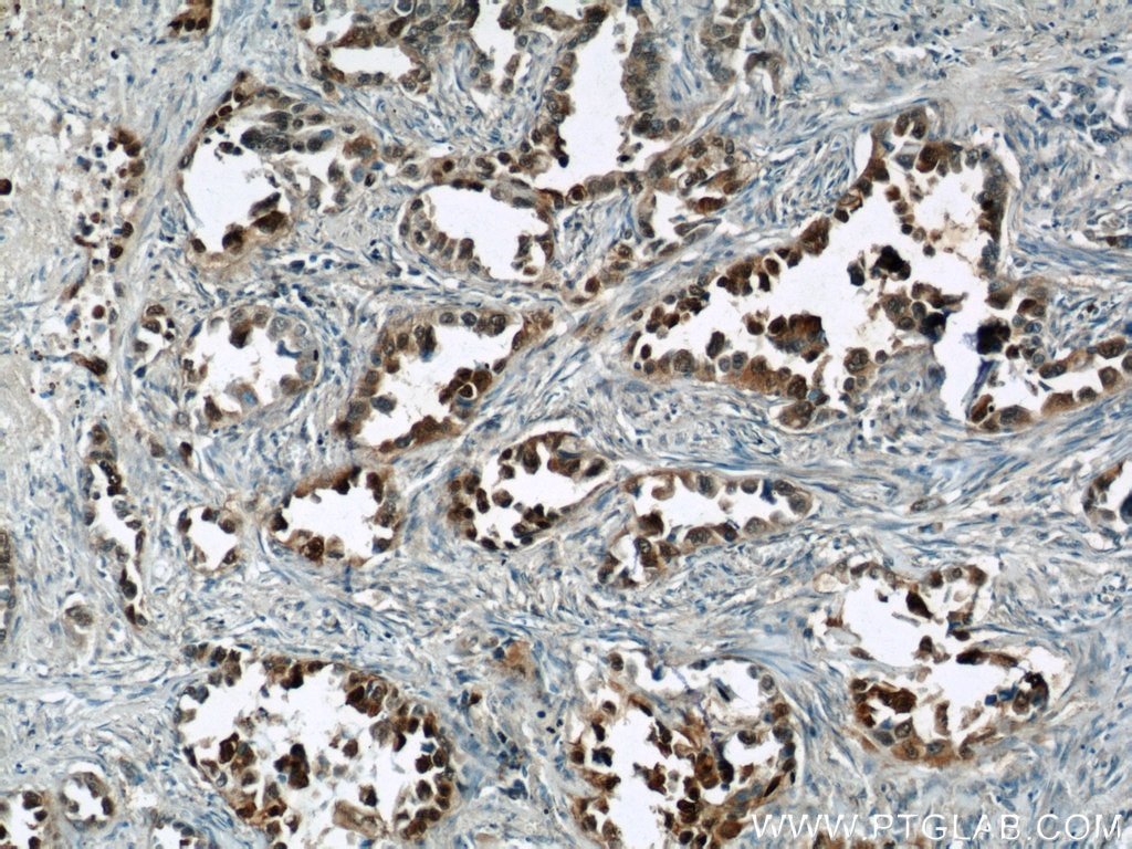 Immunohistochemistry (IHC) staining of human lung cancer tissue using S100P Polyclonal antibody (11803-1-AP)