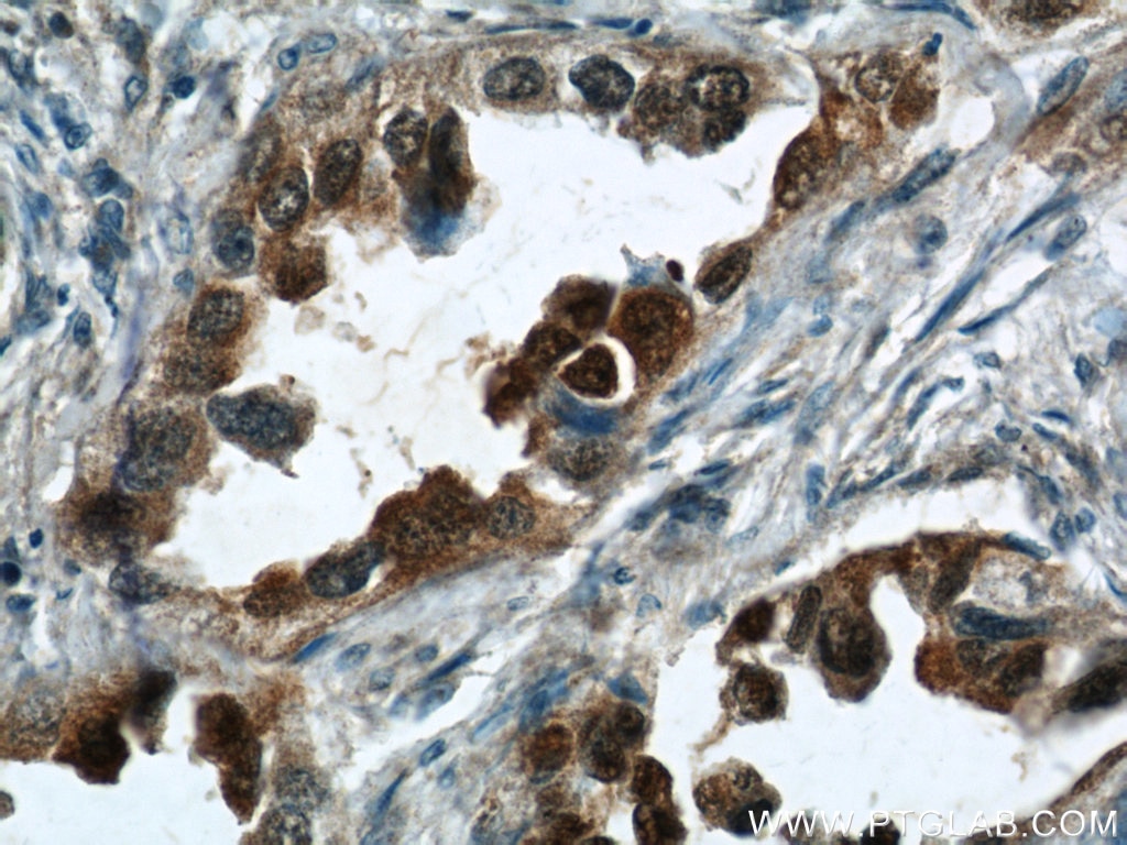 Immunohistochemistry (IHC) staining of human lung cancer tissue using S100P Polyclonal antibody (11803-1-AP)