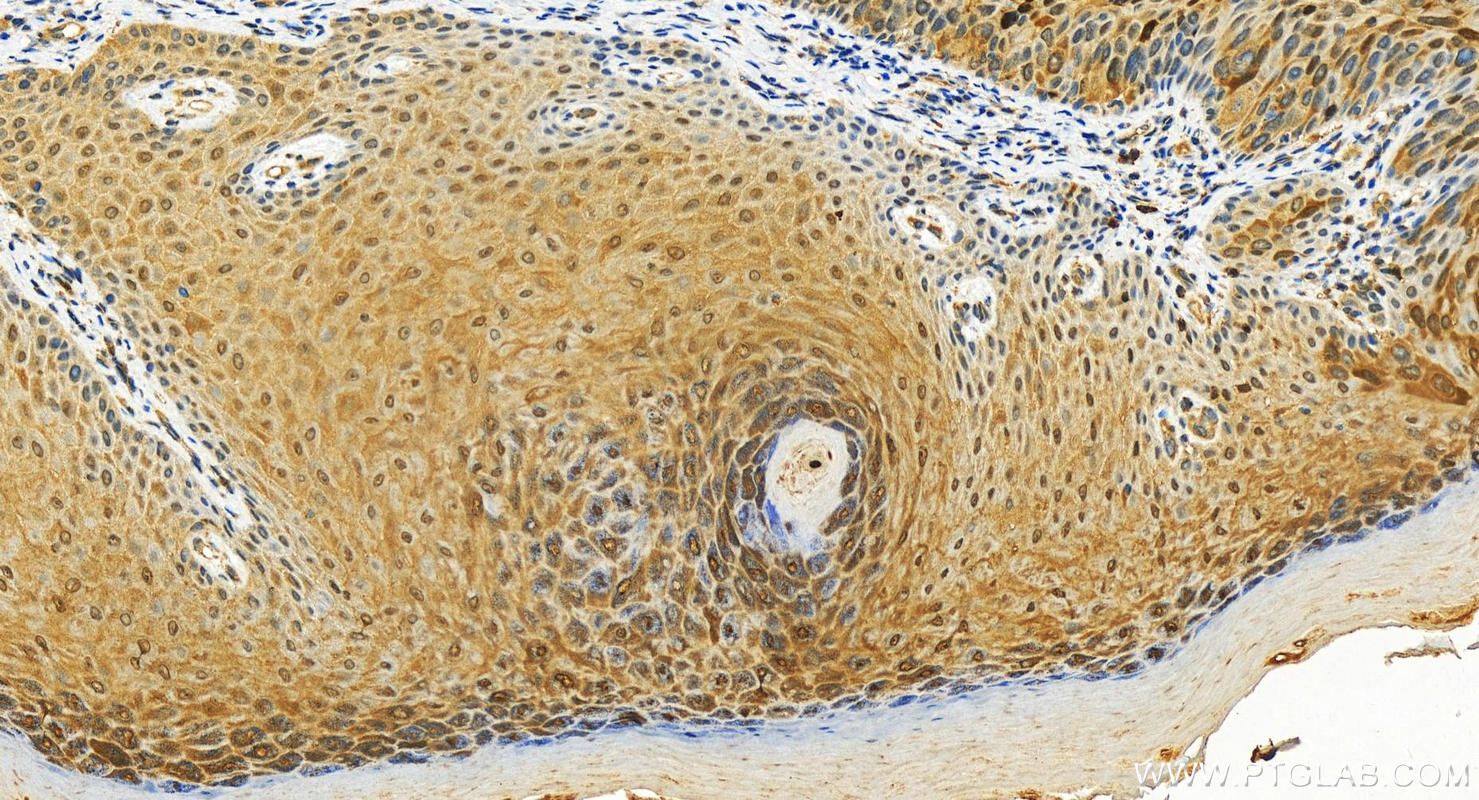 Immunohistochemical analysis of paraffin-embedded human bowen disease slide using 11803-1-AP (S100P antibody) at dilution of 1:200 (under 20x lens). Heat mediated antigen retrieval with Tris-EDTA buffer (pH 9.0). Immunohistochemistry (IHC) staining of human bowen disease tissue using S100P Polyclonal antibody (11803-1-AP)