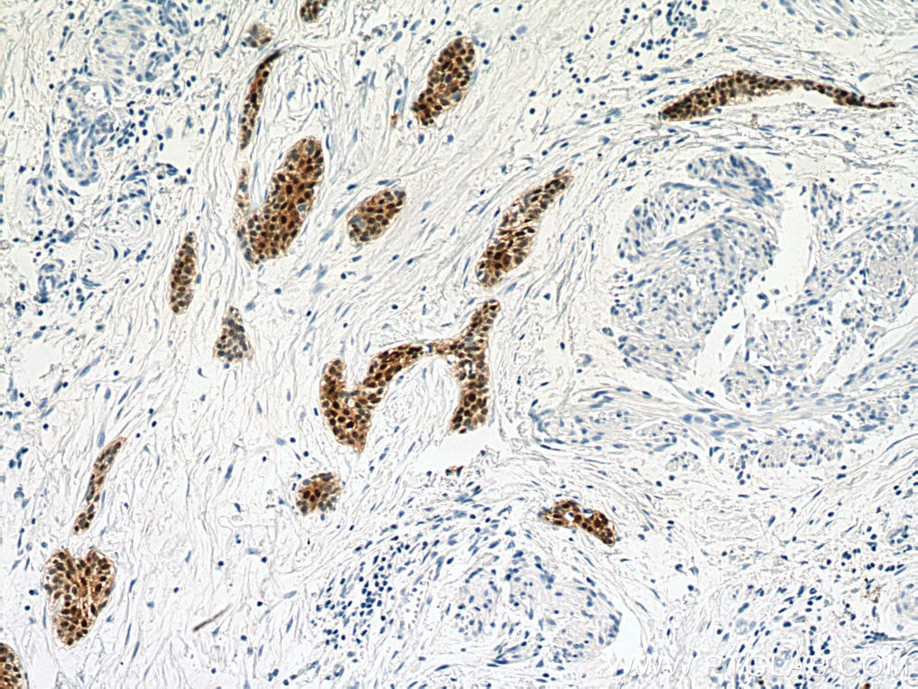 Immunohistochemistry (IHC) staining of human urothelial carcinoma tissue using S100P Monoclonal antibody (67485-1-Ig)