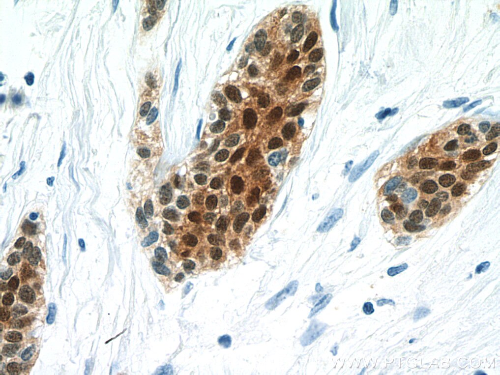 Immunohistochemistry (IHC) staining of human urothelial carcinoma tissue using S100P Monoclonal antibody (67485-1-Ig)