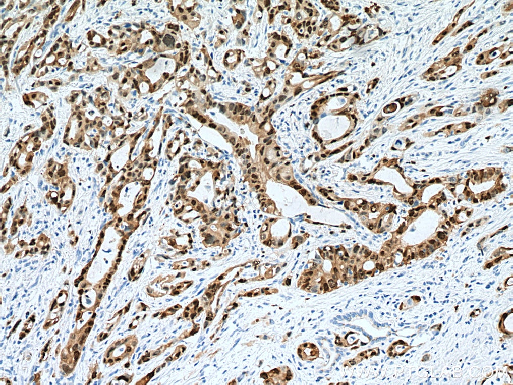 Immunohistochemistry (IHC) staining of human pancreas cancer tissue using S100P Monoclonal antibody (67485-1-Ig)