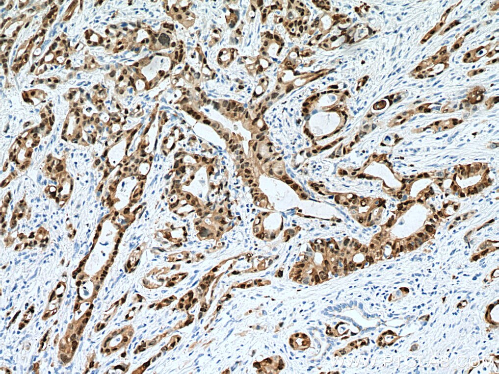 IHC staining of human pancreas cancer using 67485-1-Ig