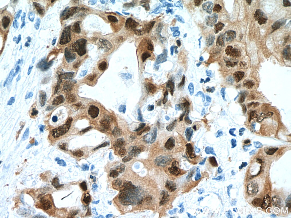 IHC staining of human pancreas cancer using 67485-1-Ig