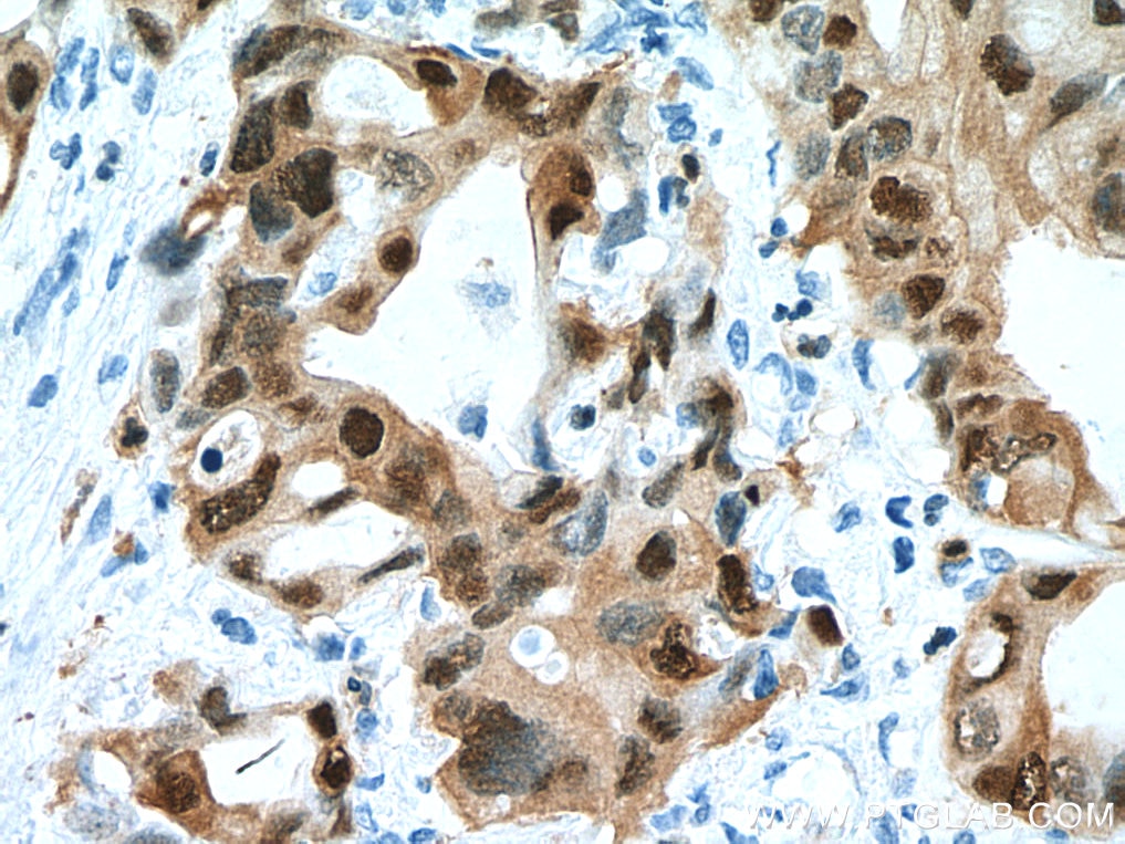 Immunohistochemistry (IHC) staining of human pancreas cancer tissue using S100P Monoclonal antibody (67485-1-Ig)