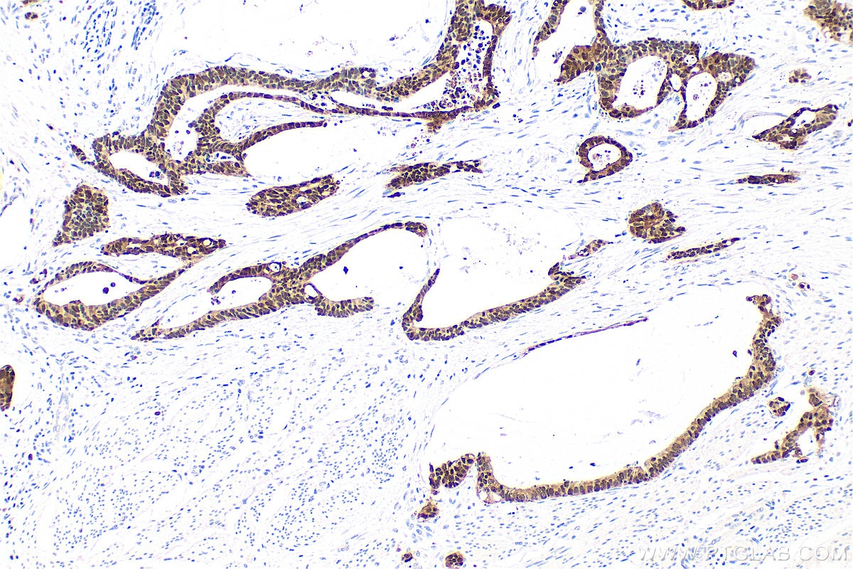 Immunohistochemistry (IHC) staining of human urothelial carcinoma tissue using S100P Monoclonal antibody (67485-1-Ig)