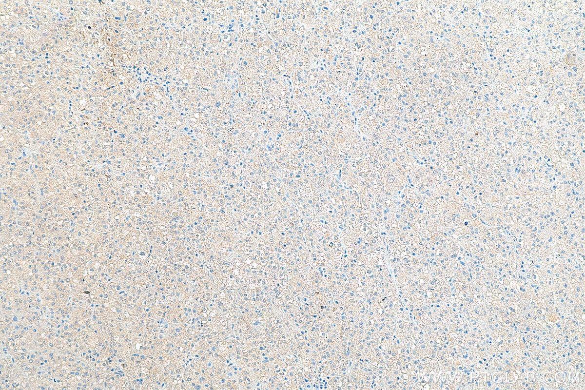 Immunohistochemistry (IHC) staining of human liver cancer tissue using SAA1 Polyclonal antibody (16721-1-AP)