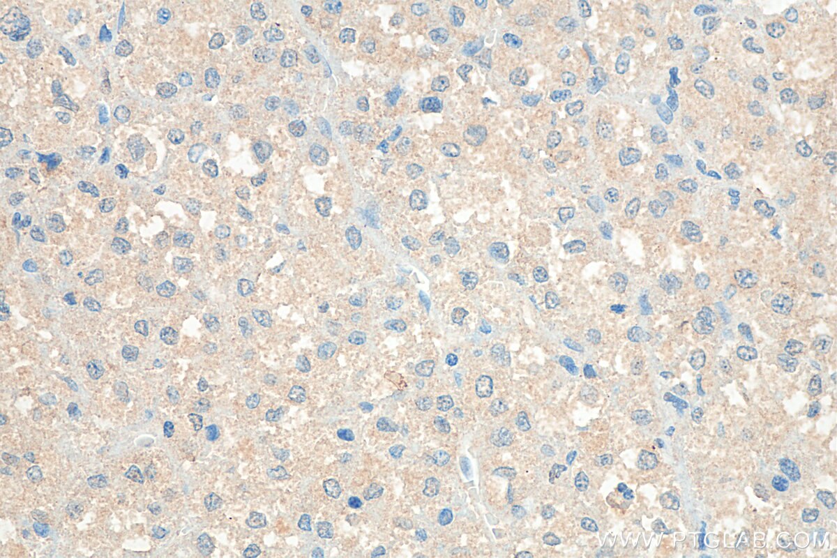 Immunohistochemistry (IHC) staining of human liver cancer tissue using SAA1 Polyclonal antibody (16721-1-AP)