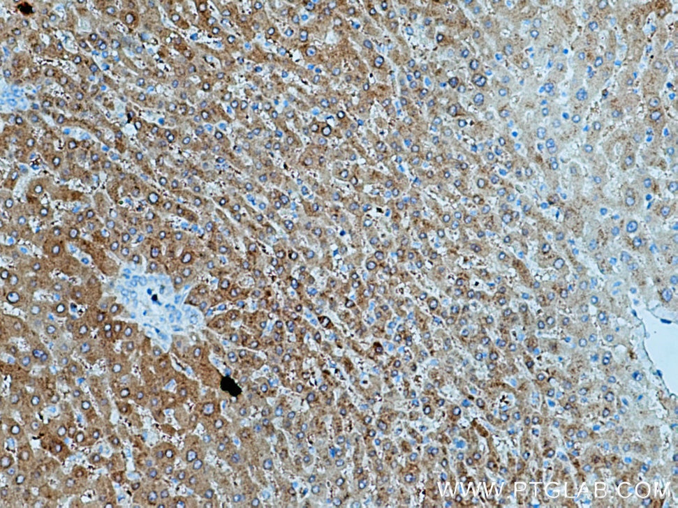 Immunohistochemistry (IHC) staining of human liver cancer tissue using SAC3D1 Polyclonal antibody (25857-1-AP)