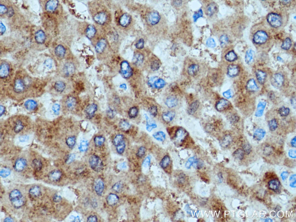 Immunohistochemistry (IHC) staining of human liver cancer tissue using SAC3D1 Polyclonal antibody (25857-1-AP)