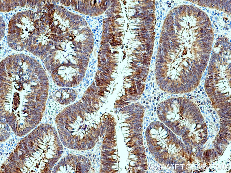 Immunohistochemistry (IHC) staining of human colon cancer tissue using SAC3D1 Polyclonal antibody (25857-1-AP)